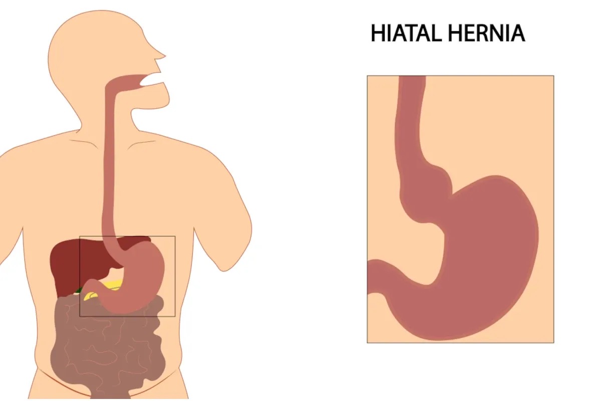 Ernia iatale: sintomi, rischi e soluzioni per una vita senza bruciore